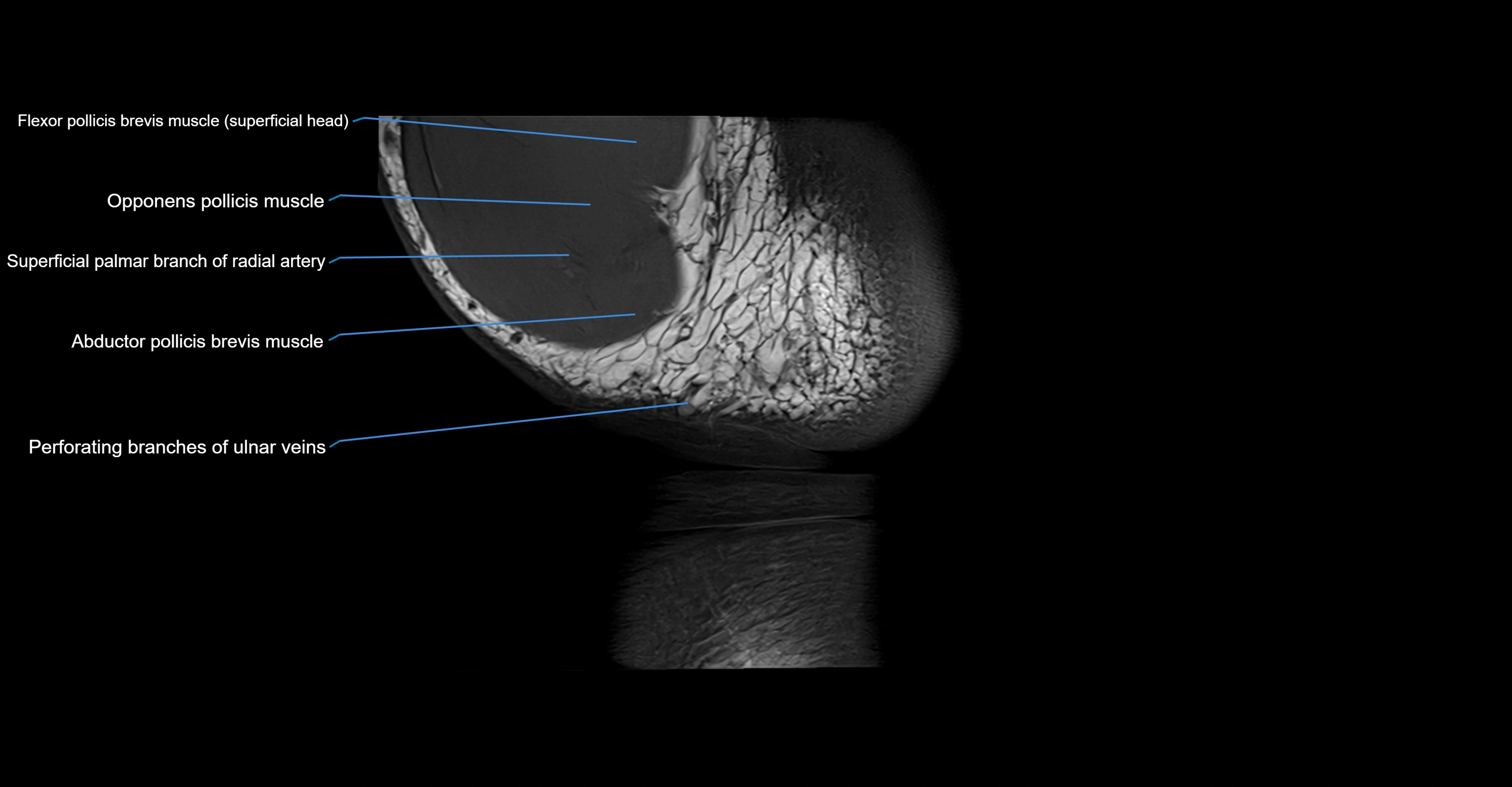 MRI wrist coronal cross sectional anatomy 3T  radiology  image-img-00001-00026.webp